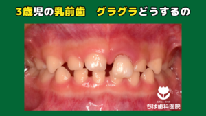 3歳児の乳前歯 グラグラどうするの｜ちば歯科医院 | 奥州市水沢 予防 